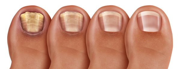 The Hidden Dangers of Untreated Toenail Fungus: What You Need to Know